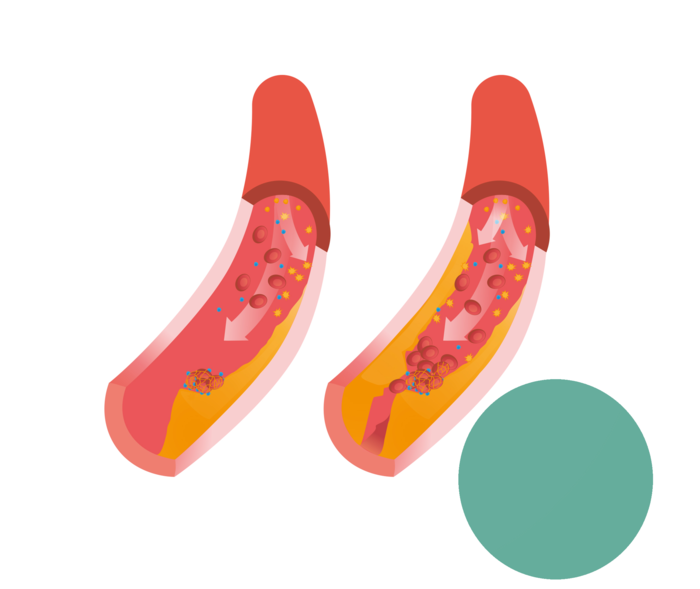 Lipide-Info: Die Illustrationen zeigen den Unterschied zwischen einer beginnenden und einer starken Atherosklerose (rechts) Die Illustrationen zeigen den Unterschied zwischen einer beginnenden und einer starken Atherosklerose (rechts)