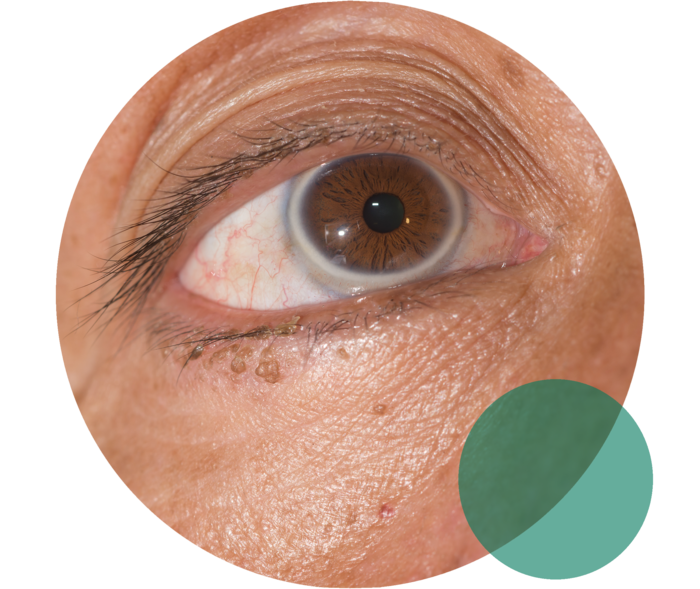 Greisenbogen bei Hypercholesterinämie Ein geöffnetes Auge. Um die Iris zeigt sich ein trüber, milchig-weißer Ring.