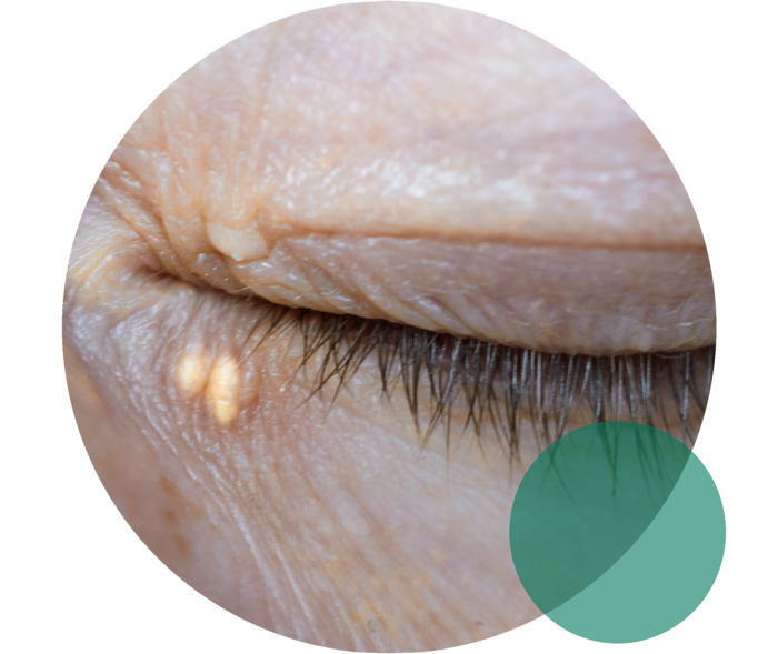Hohes Cholesterin: Symptom Xanthelasmen Ein geschlossenes Auge. Unterhalb des Auges sind an der Haut zwei gelbliche Ablagerungen zu sehen.