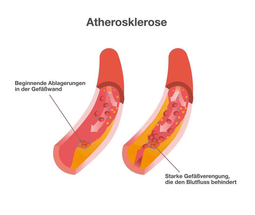 Atherosklerose: Wenn die Blutbahn verengt ist Grafik mit der Überschrift „Atherosklerose“. Sie zeigt zwei Blutgefäße. Im linken Gefäß sind wenige gelbliche Ablagerungen zu sehen. Beschriftung: „Beginnende Ablagerungen in den Gefäßwänden“. Im rechten Blutgefäß sind rechts und links stark ausgeprägte gelbliche Ablagerungen zu sehen. Beschriftung: „Starke Gefäßverengung, die den Blutfluss behindert“.