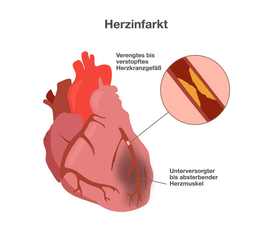 Verschluss im Herzen: Herzinfarkt Eine Grafik mit der Überschrift „Herzinfarkt“. Anatomische Darstellung eines Herzens mit Herzkranzgefäß. Eine Stelle unter dem Herzkranzgefäß ist gräulich verfärbt. Beschriftung: „Unterversorgter bis absterbender Herzmuskel“. Rechts neben dem Herzen die vergrößerte Ansicht des Herzkranzgefäßes. Sie zeigt eine schmale Röhre, die durch gelbliche Ablagerungen verengt ist. Beschriftung: „Verengtes bis verstopftes Herzkranzgefäß“.