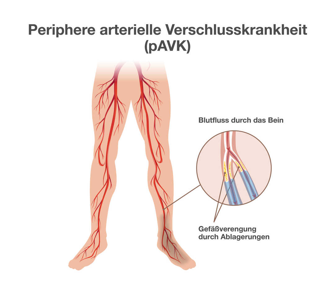 PAVK: Gefäßverengung durch Ablagerungen Grafik mit der Überschrift „Periphere arterielle Verschlusskrankheit (pAVK)“. Sie zeigt Beine eines Menschen mit rot gefärbten Blutgefäßen. Rechts daneben die vergrößerte Ansicht eines Blutgefäßes mit zwei Abzweigungen. Überschrift: „Blutfluss durch das Bein“. In den beiden Abzweigungen sind gelbe Ablagerungen zu erkennen. Unterhalb der Ablagerungen sind die Abzweigungen blau gefärbt. Beschriftung: „Gefäßverengung durch Ablagerungen“.