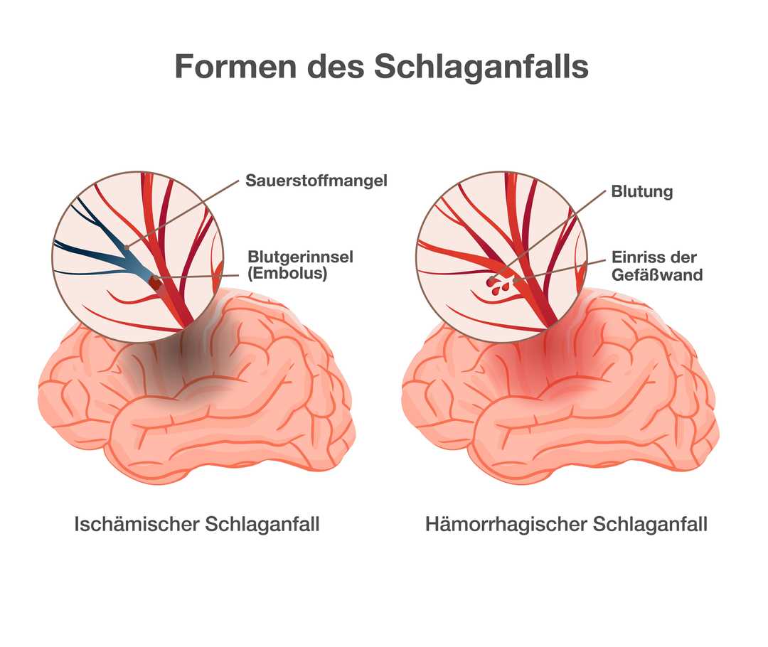 Kipide.info: Schlaganfall Grafik mit der Überschrift „Formen des Schlaganfalls“. Dargestellt sind zwei Gehirne. Links die Darstellung des ersten Gehirns. Beschriftung: „Ischämischer Schlaganfall“. Die Vergrößerung eines Bereichs zeigt Blutgefäße im Gehirn. Die Abzweigung eines Blutgefäßes ist blau verfärbt. Beschriftung: „Sauerstoffmangel“. Unterhalb der blauen Verfärbung ist ein Blutgerinnsel zu erkennen. Beschriftung: „Blutgerinnsel (Embolus)“. Rechts die Darstellung des zweiten Gehirns. Beschriftung „Hämorrhagischer Schlaganfall“