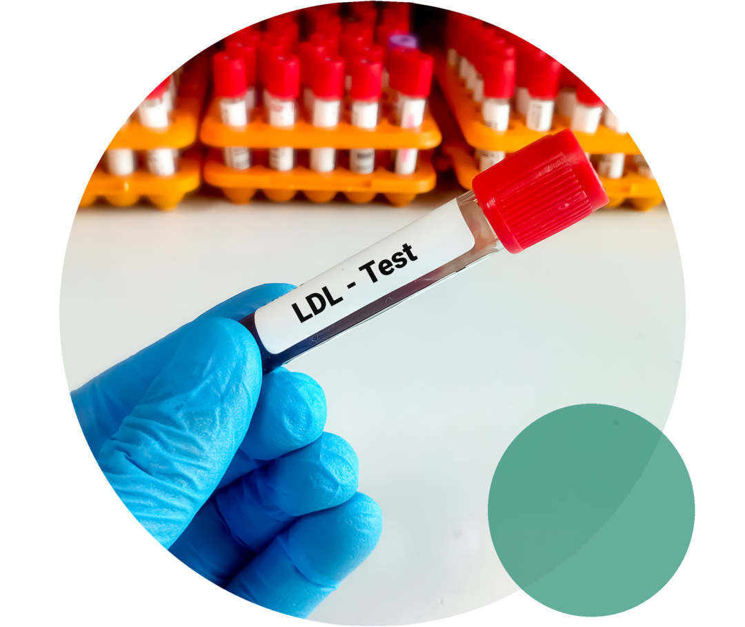 Hypercholesterinämie: Cholesterin-Test Eine Hand im blauen Einweghandschuh hält ein Probenröhrchen mit der Aufschrift „LDL-Test“.
