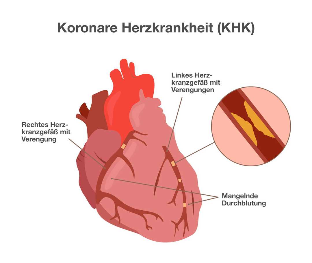 Koronare Herzkrankheit: Verengte Herzkranzgefäße Eine Grafik mit der Überschrift: Koronare Herzkrankheit (KHK). Anatomische Darstellung eines Herzens mit den Herzkranzgefäßen. Über das Herz ziehen sich Blutgefäße. Beschriftung eines der Gefäße mit: Rechtes Herzkranzgefäß mit Verengung. Beschriftung eines anderen Gefäßes mit: Linkes Herzkranzgefäß mit Verengungen. Vergrößerte Darstellung eines Teils des linken Herzkranzgefäßes. Untere Teile des Herzens beschriftet mit: Mangelnde Durchblutung.